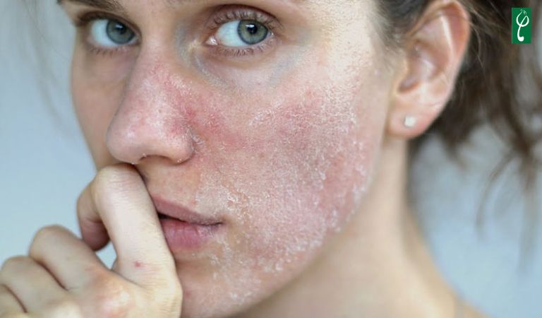 Da bị khô do tác hại của tia UV, thói quen chăm sóc và bảo vệ da không đúng cách