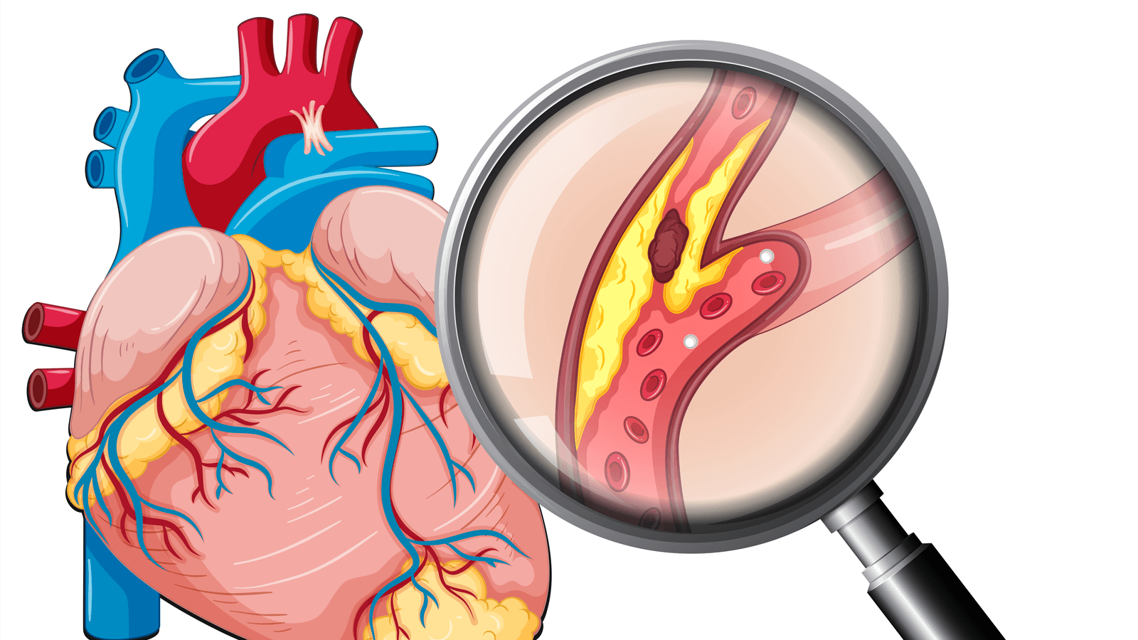 Biến chứng tim mạch của bệnh  tiểu đường có thể gây xơ vữa động mạch.