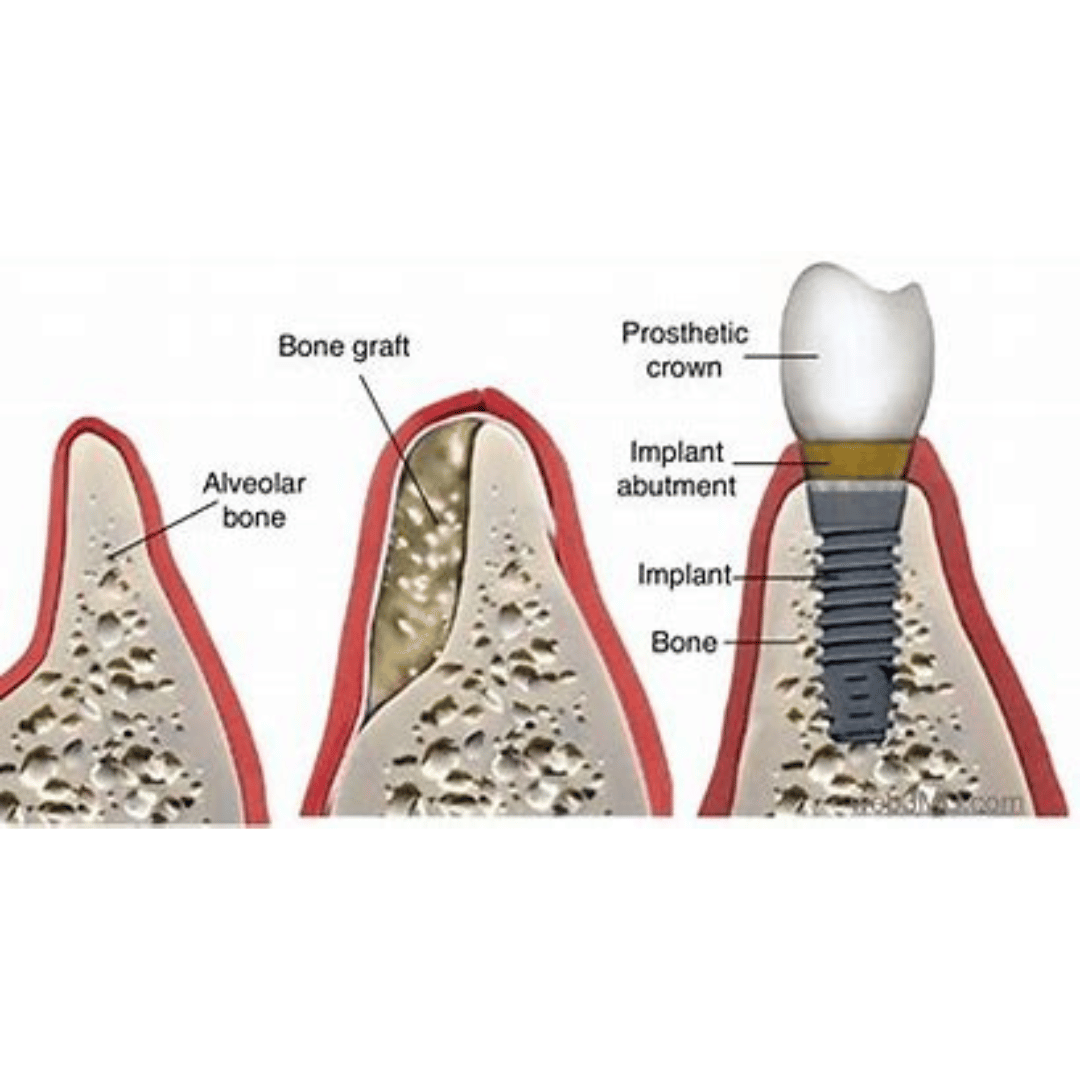 Bone Graft For Dental Implant