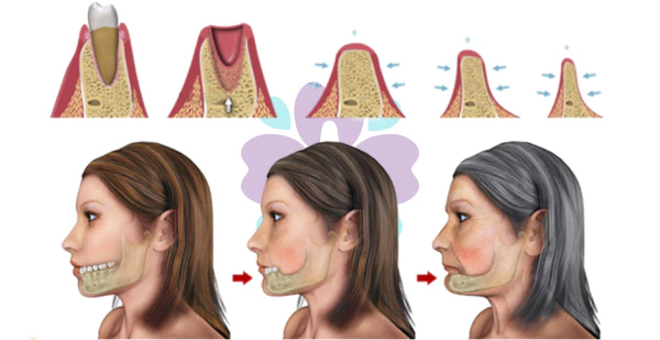 Hình minh họa của Camtu Dental cho thấy quá trình tiêu xương ở hàm theo thời gian sau khi mất răng, với mặt cắt chi tiết về mật độ xương hàm.