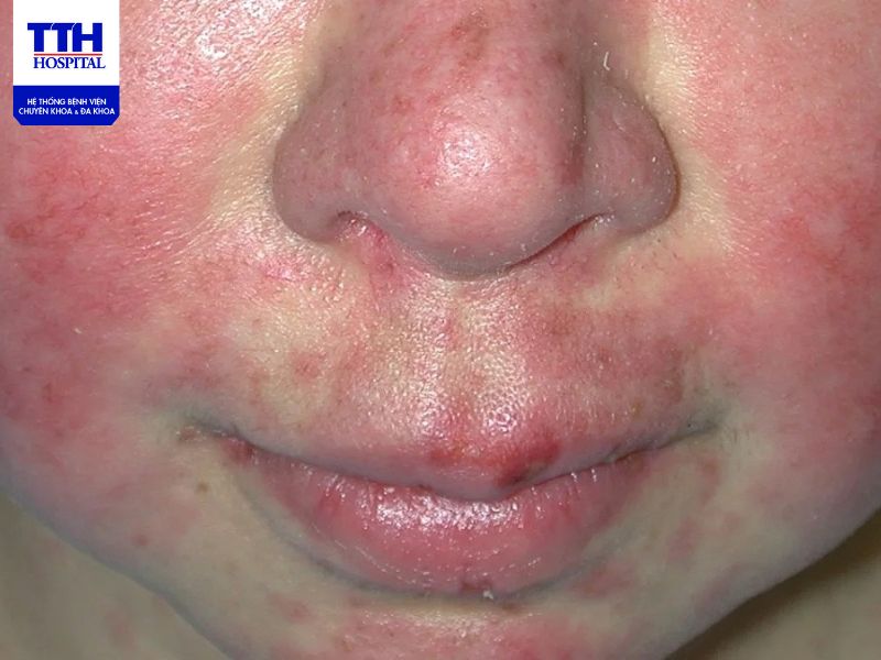 Biện pháp giúp cải thiện chất lượng cuộc sống khi mắc bệnh lupus ban đỏ