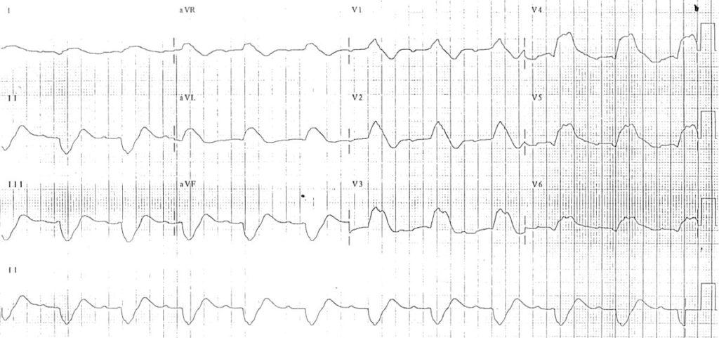 ECG Hyperkalemia prolonged PR bizarre QRS complexes