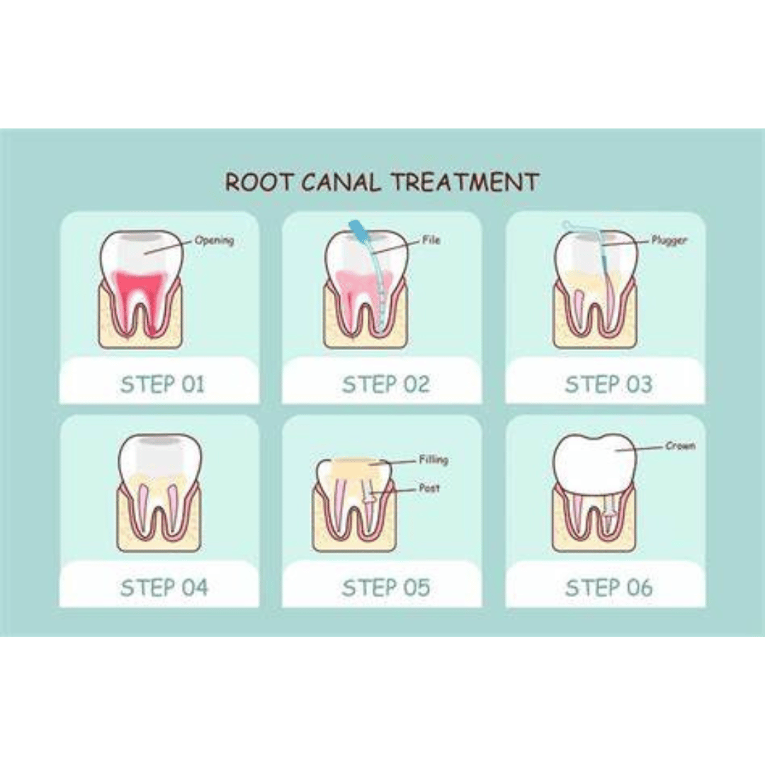 Root Canal Therapy