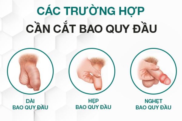 Trường hợp cần cắt bao quy đầu