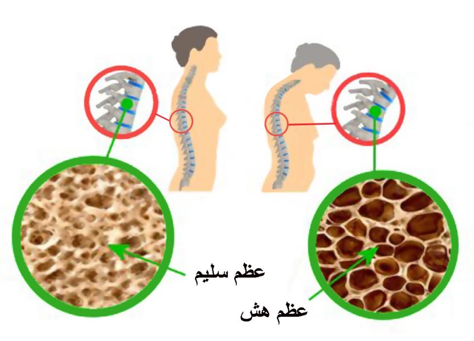 Osteoporosis1.jpg