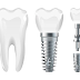 Top 5 loại trụ Implant được ưa chuộng nhất hiện nay