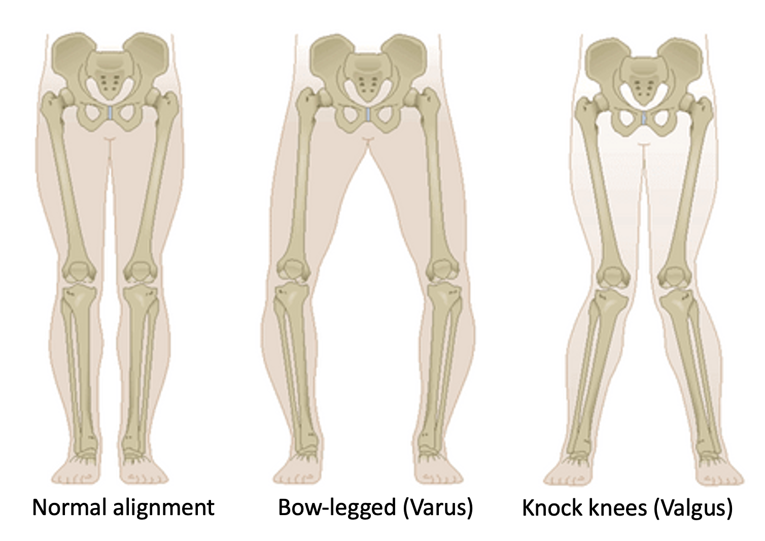 lower-limb-alignments
