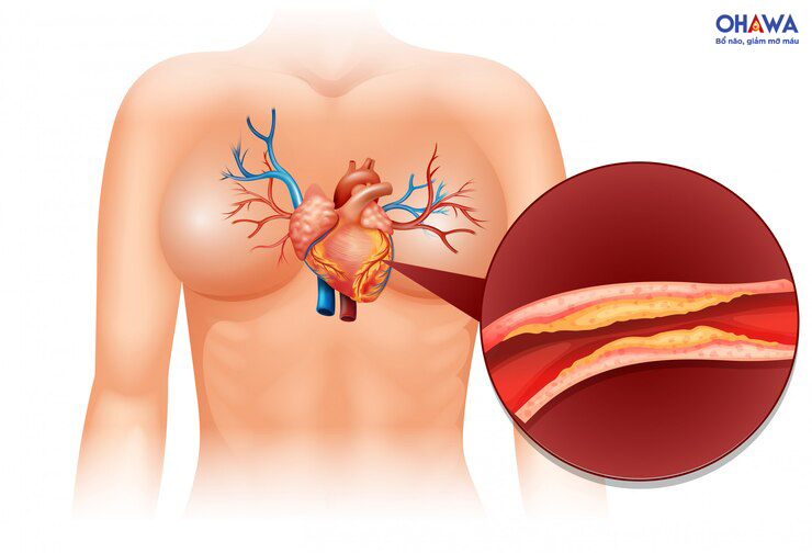 Cholesterol cao là nguyên nhân gây ra bệnh tim mạch vành