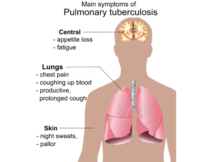 Pulmonary Tuberculosis - DoveMed