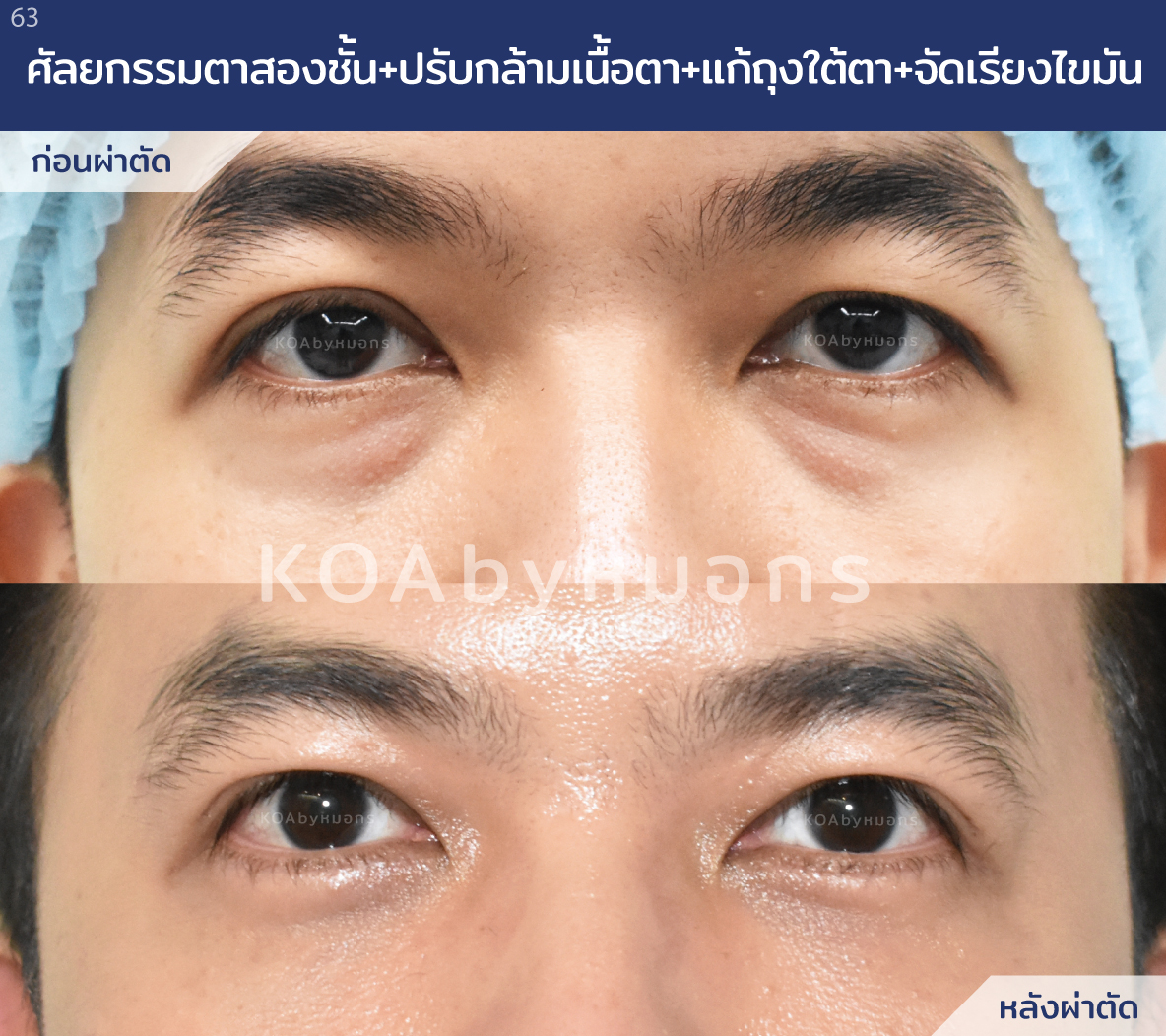 รีวิวศัลยกรรมตาสองชั้น ร่วมกับปรับกล้ามเนื้อตา แก้ถุงใต้ตา ก่อนทำและหลังทำ