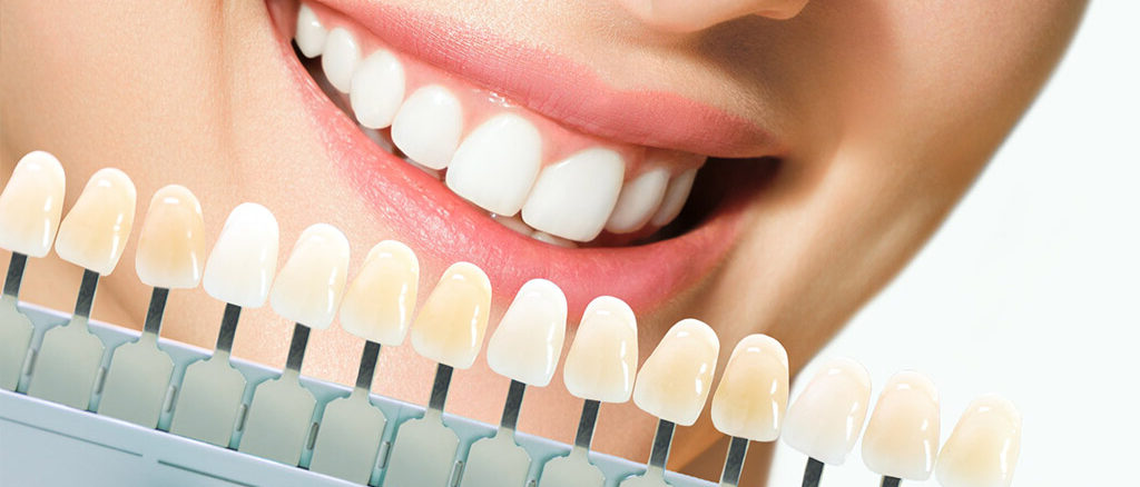 Dental veneers consultation in Burnaby