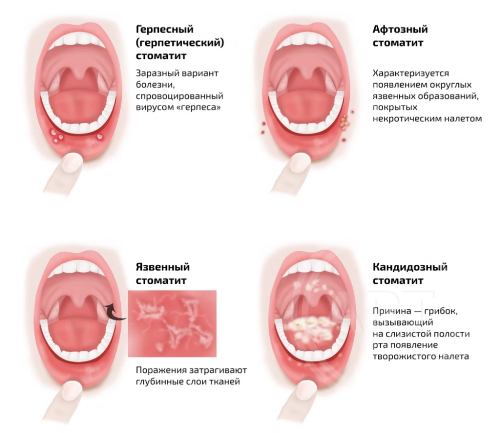 Стоматит у детей: причины возникновения, как лечить в домашних условиях