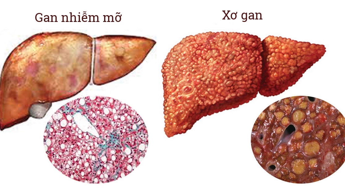 Chụp cộng hưởng từ gan và những điều cần biết 2