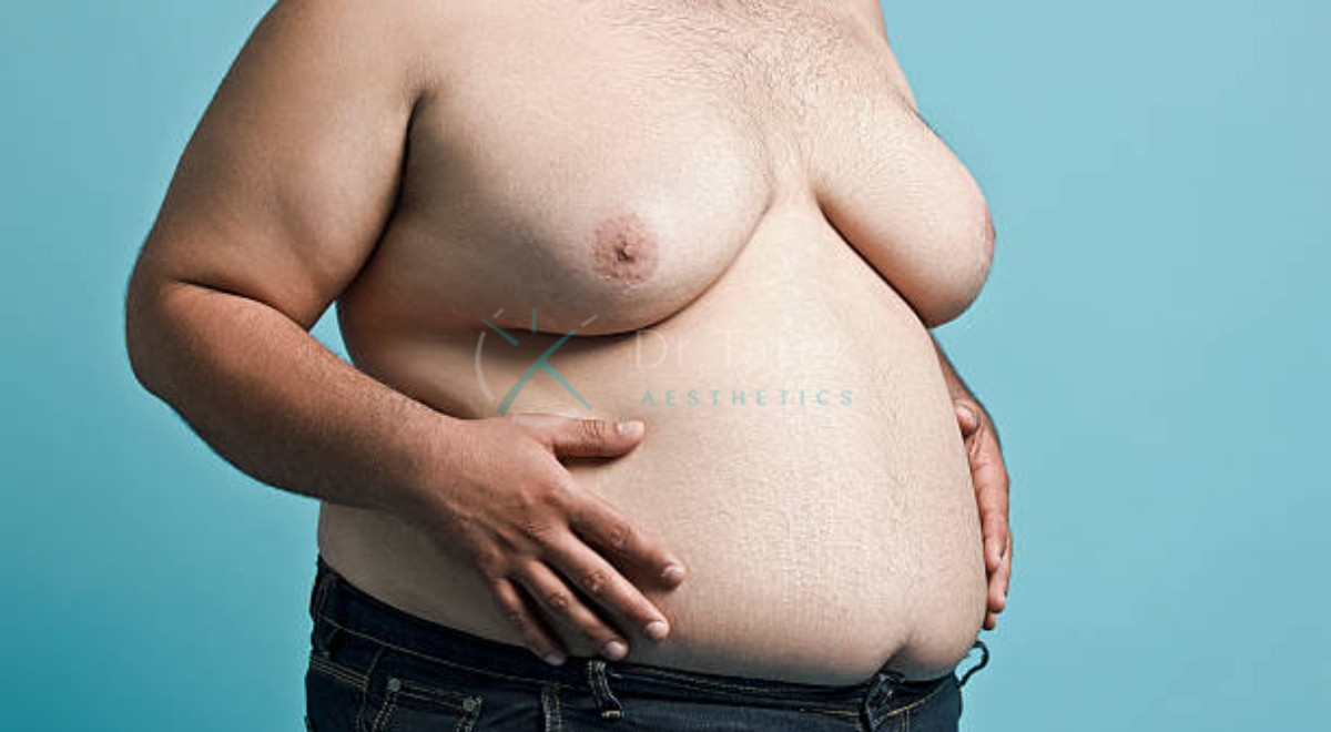 Plastic Surgeon For Gynecomastia An Overview By Dr.tarek