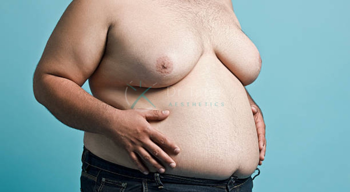 Plastic Surgeon For Gynecomastia An Overview By Dr.tarek 5 Dr. Tarek Aesthetics | Best Plastic Surgeon In Dubai Plastic Surgeon For Gynecomastia An Overview By Dr.tarek