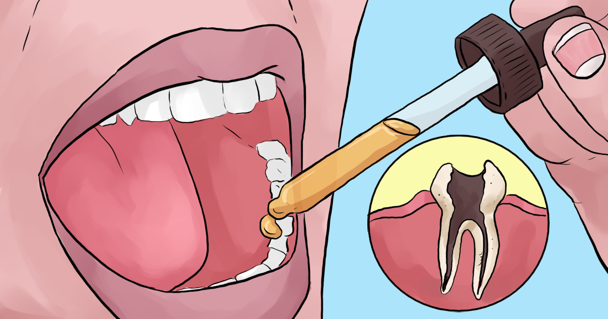 استخدام زيت القرنفل لتخفيف آلام الأسنان