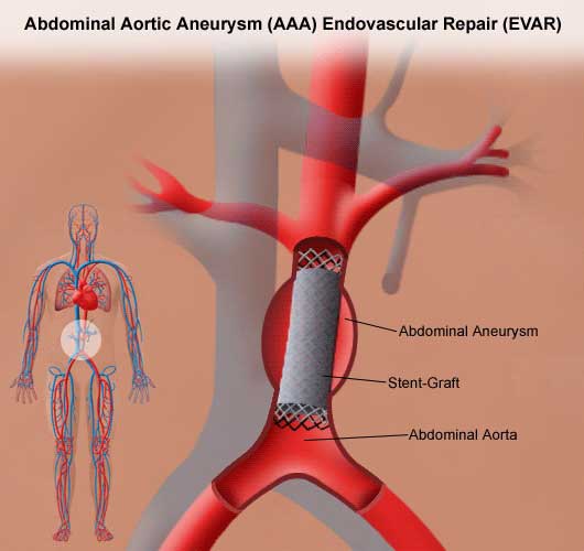 During Your Endovascular Aneurysm Repair (EVAR) | Stanford Health Care