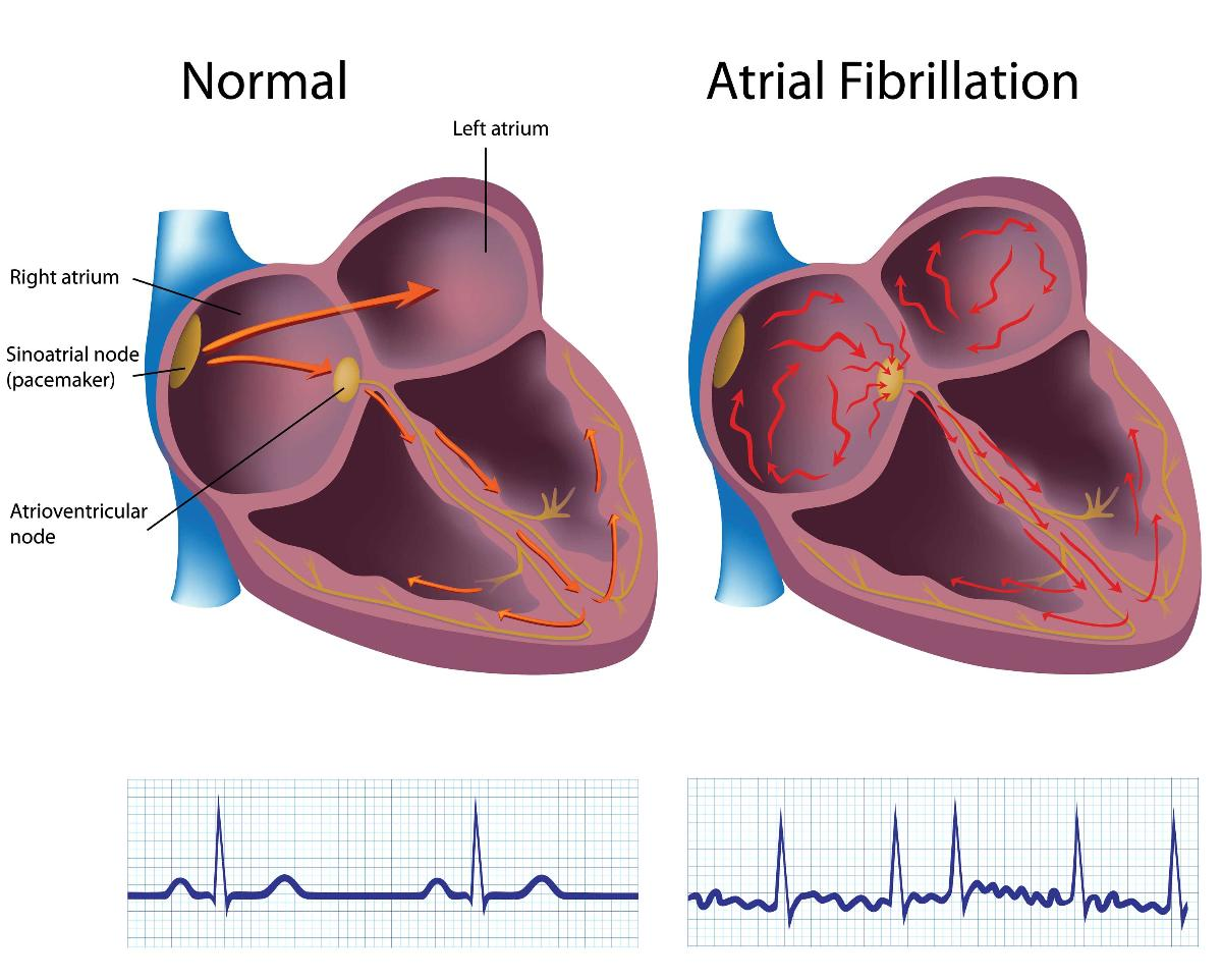  Atrial Fibrillation