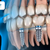 Viêm nha chu có thể gây ra những vấn đề về tích hợp hoặc sự ổn định của trụ Implant Hàn Quốc không?