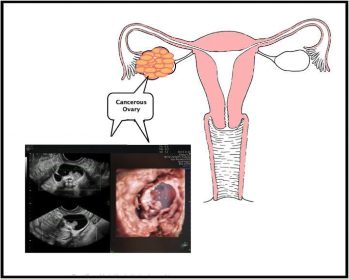 Risks of Ovarian Cancer Treatments to the Fetus
