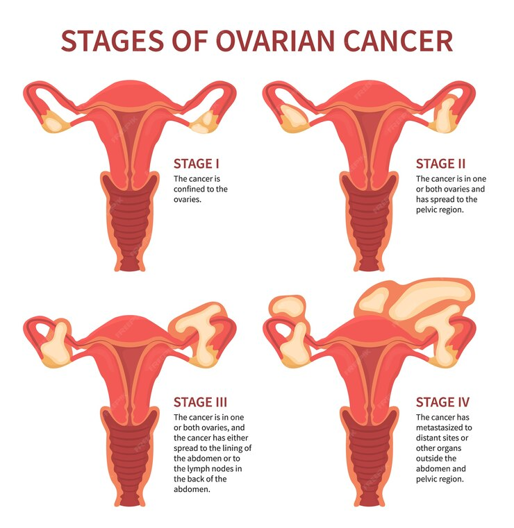 Stages of ovarian cancer