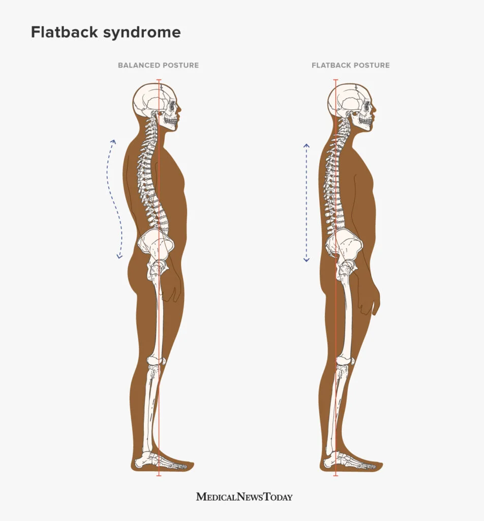 Posture Matters: How Physiotherapy Can Improve Your Alignment