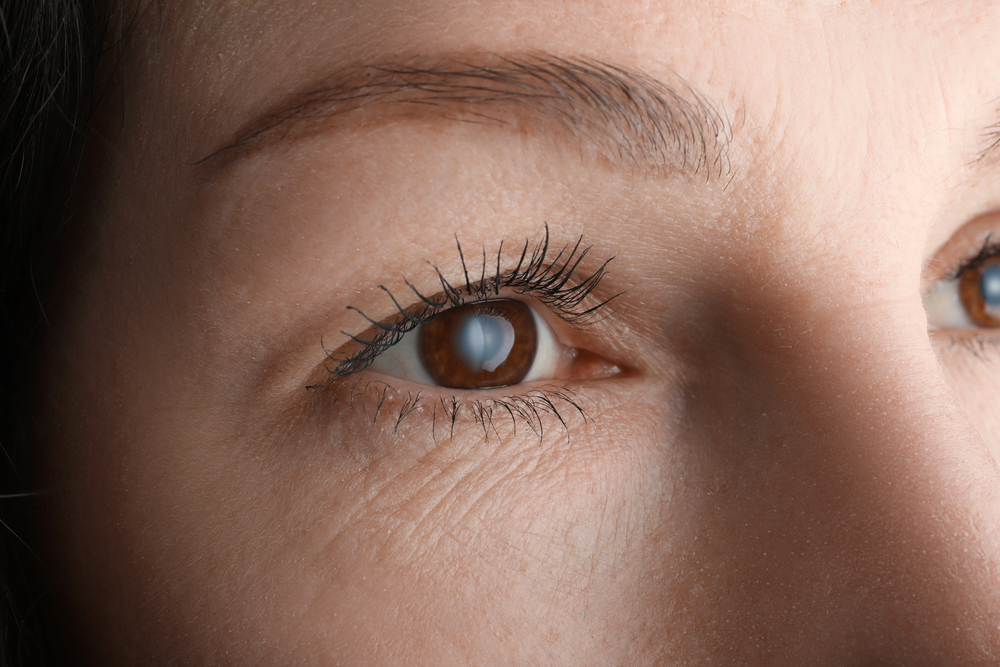 cataract-eye