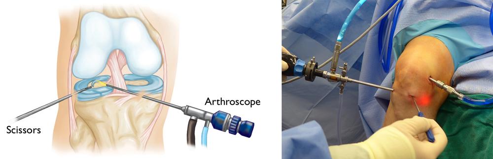 Knee arthroscopy