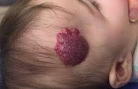 Cavernous Hemangioma - MEDizzy