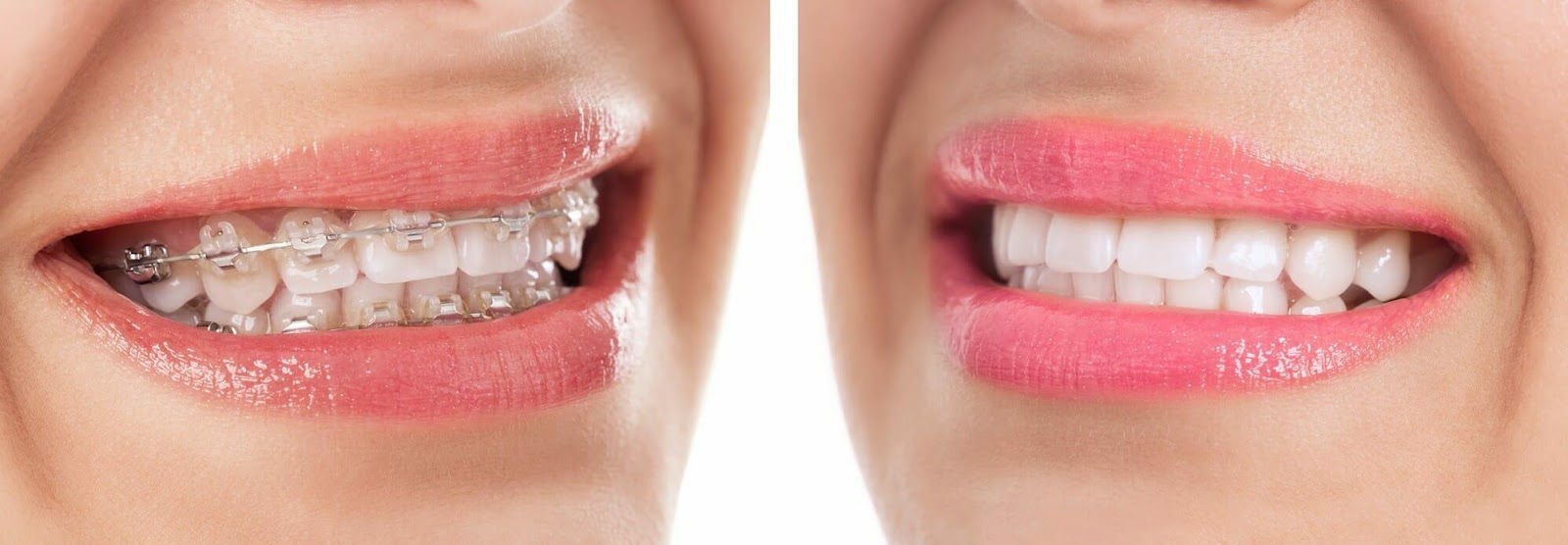 teeth whitening in Vancouver
