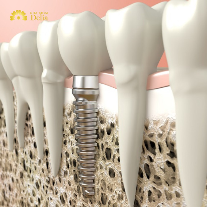 Ghép xương răng nhằm cung cấp nền tảng vững chắc cho trụ Implant
