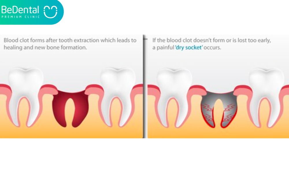 Why is wisdom tooth removal needed?