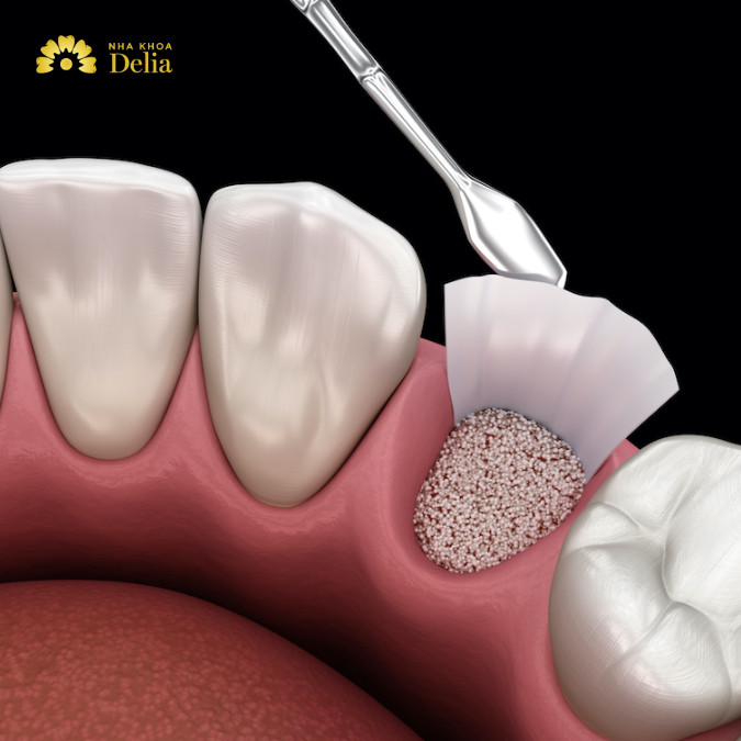 Ghép xương răng để phục hồi hình dạng và chức năng của xương hàm