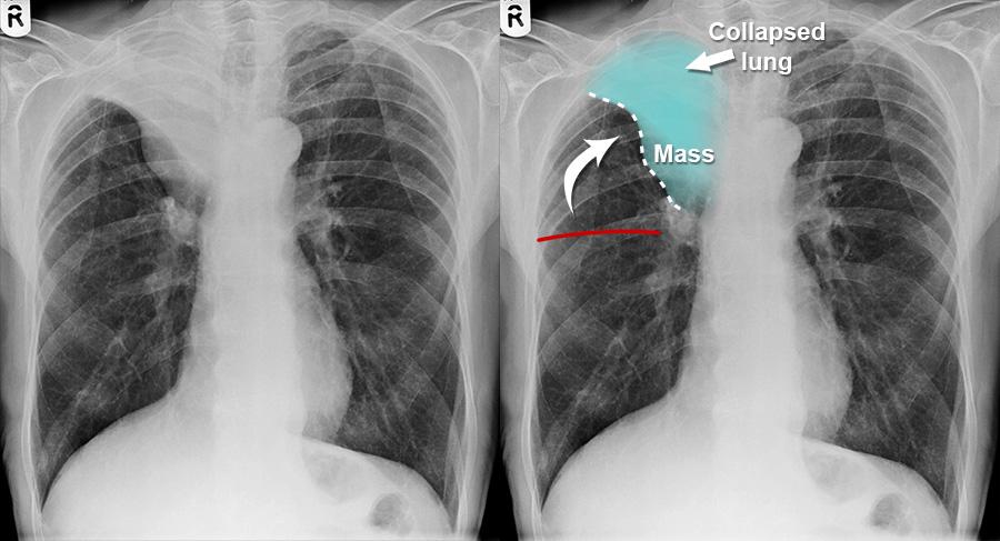 Chest X-ray - Lung cancer - Lobar collapse