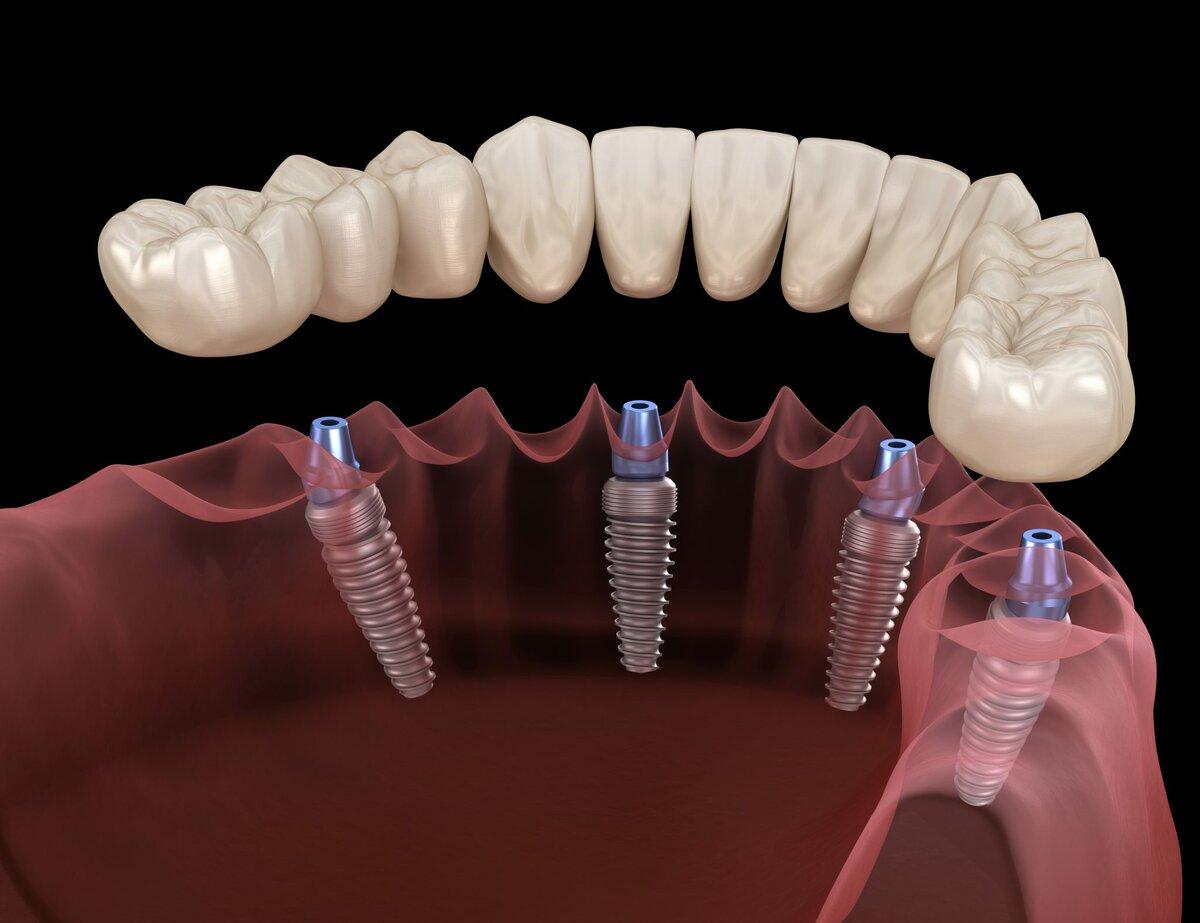 dental implants in North York