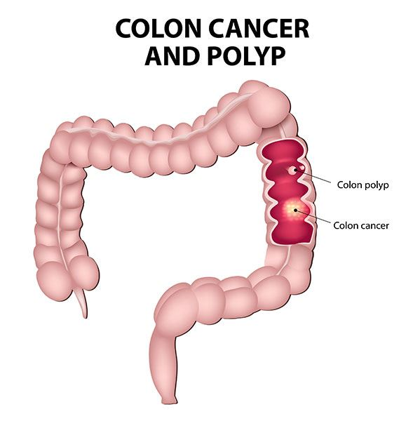 Colon Cancer