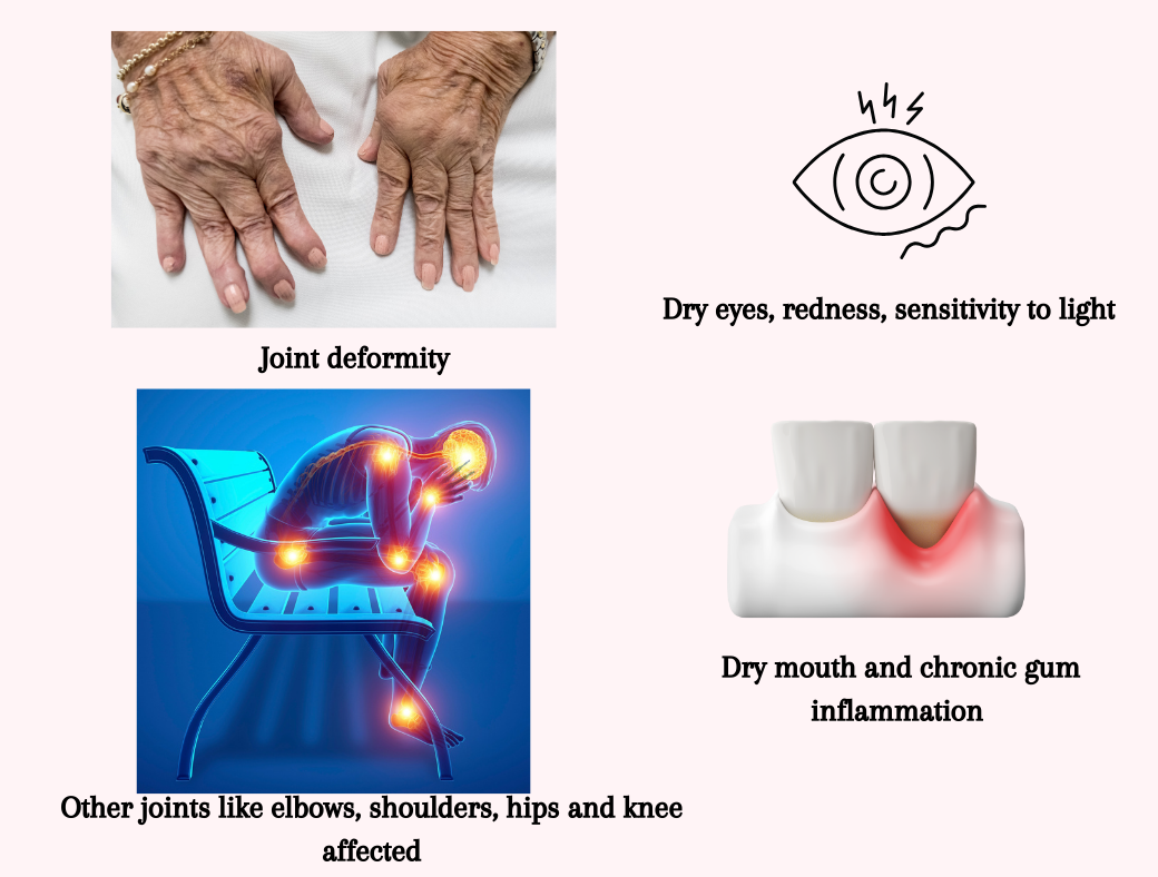 Later stages of Rheumatoid Arthritis where joints become deformed and other symptoms | Yi TCM