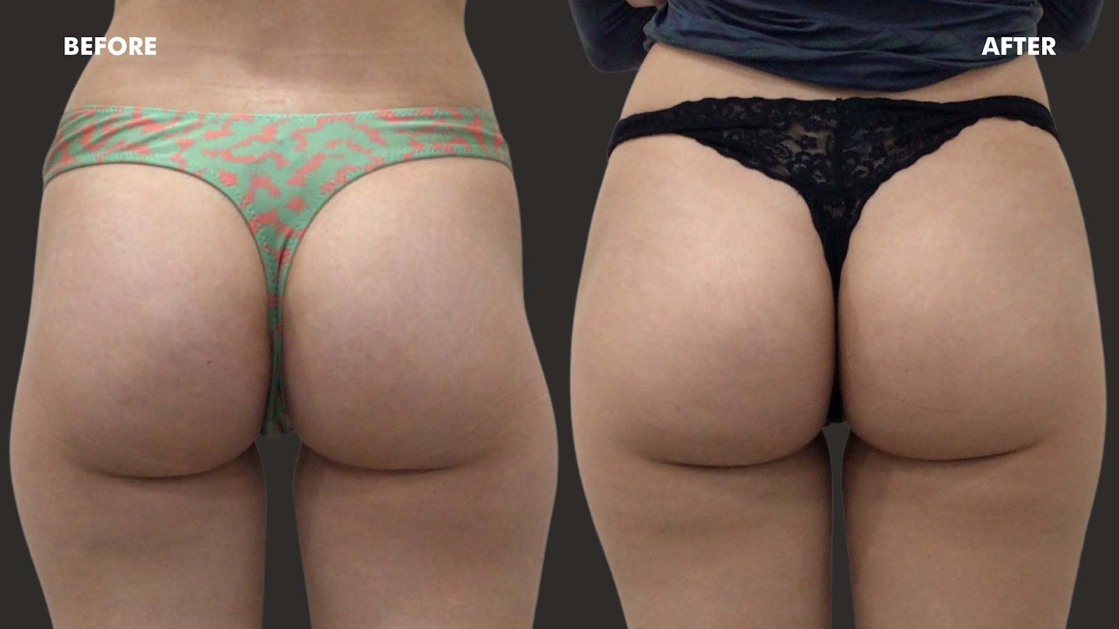 Before and after of buttocks.