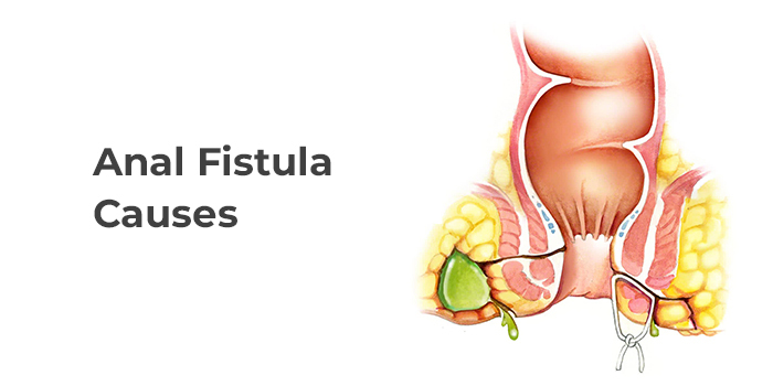 Fistula causes