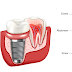 Cách tính giá trồng răng Implant đơn giản và chính xác