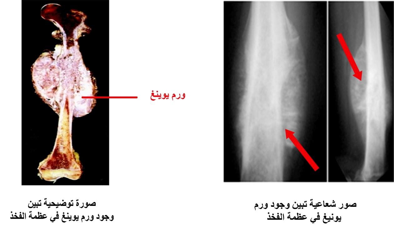 E:\Documents and Settings\USER\Desktop\Shared Files\bone cancer\يوينغ.jpg