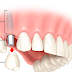 Tư vấn cấy ghép Implant để phục hình răng mất hoàn hảo nhất !