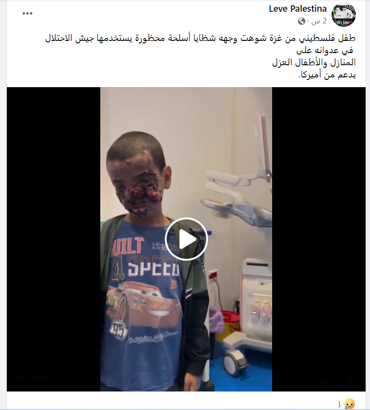لقطة شاشة من فيديو ادعى ناشروه أنه لطفل من غزة مُصاب بأسلحة محظورة أستخدمها الاحتلال/إكس