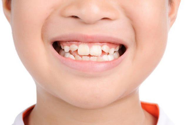 Răng mọc lệch là gì? Các phương pháp điều trị hiệu quả