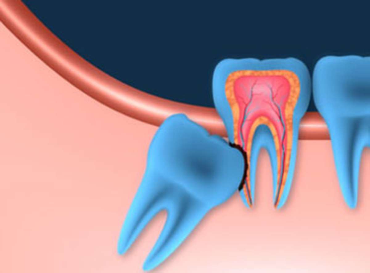 Dental Wisdom Revealed
