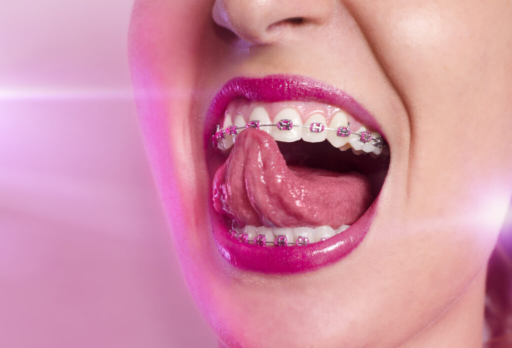 WHITE WOMAN WITH HOT PINK BRACES ON