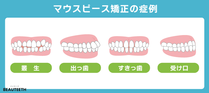 マウスピース矯正の適応症例