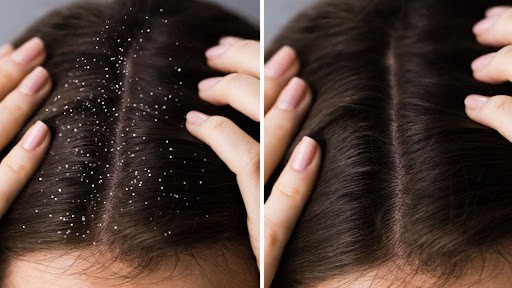 How Do I Stop Dandruff And Hairfall: Proven Solutions