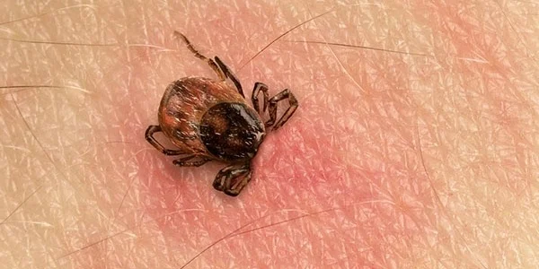 Photo of a tick on human skin. The skin is inflammed.