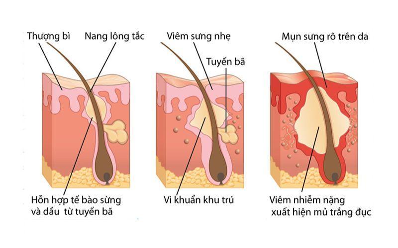 Mụn viêm